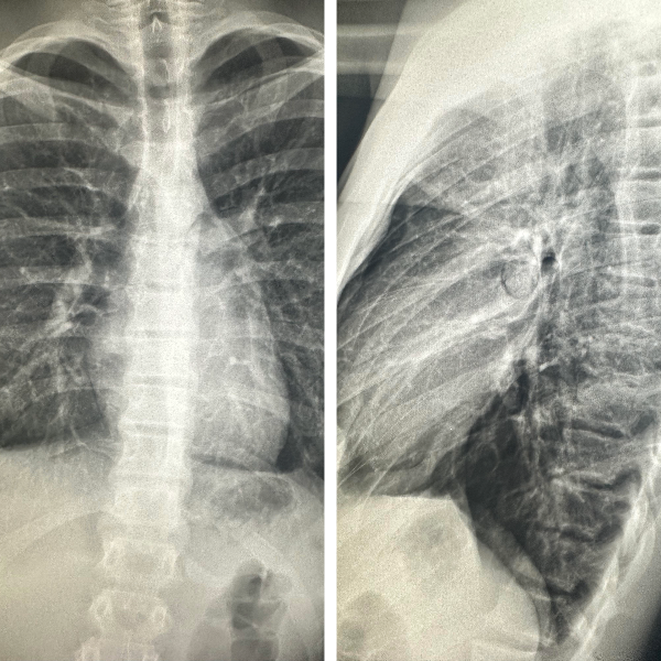 The case of a suddenly painful chest
